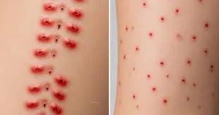 عکس جای نیش کنه